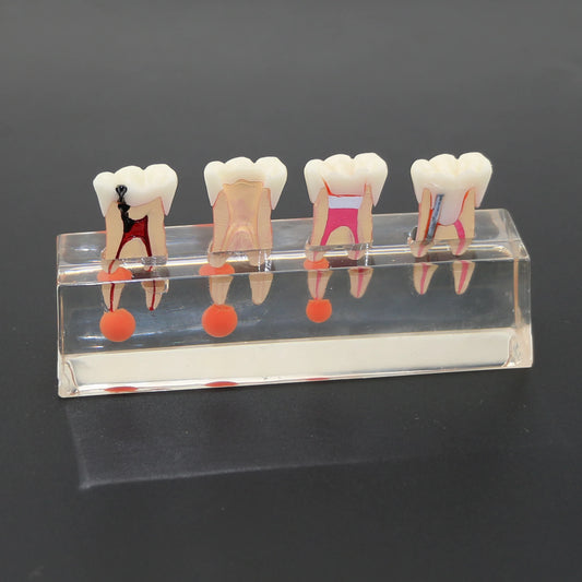 Dental Teeth Model 4-Stage Endodontic Treatment Clear Demonstrates Model for Study Teaching Clinic Decoration
